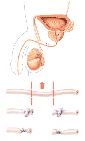 Vasectomie; stérilisation masculine