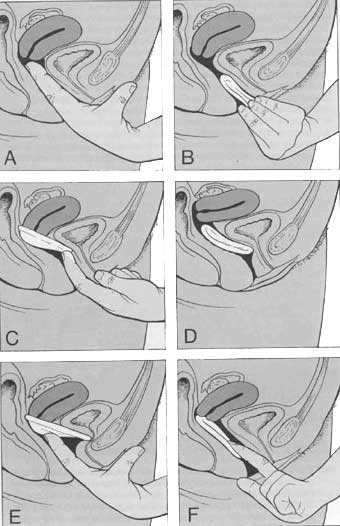 Mise en place du diaphragme