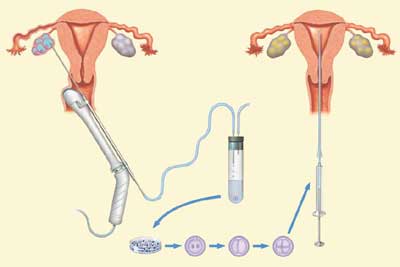 IVF; fertilisation In Vitro