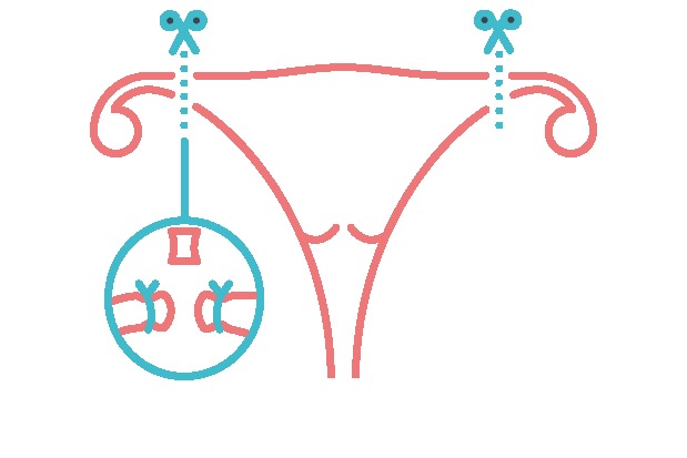 stérilisation féminine