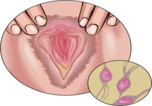 trichomonas