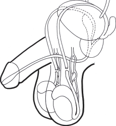 vasectomie