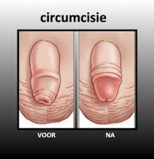 circoncision