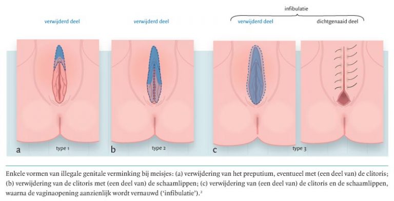 circoncision